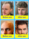 Rapid Hair Growth