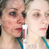 Melasma Brightening Cream