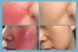 Anti-Redness Repair Serum