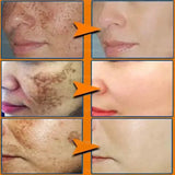 Melasma Brightening Cream