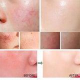 Anti-Redness Repair Serum