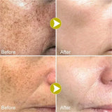 Melasma Brightening Cream