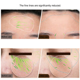RF EMS Skin Tightening Device