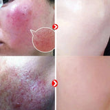 Anti-Redness Repair Serum