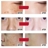 Melasma Brightening Cream