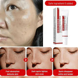 Melasma Brightening Cream