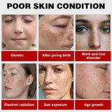 Melasma Brightening Cream