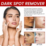 Melasma Brightening Cream