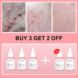 Peptide Acne Serum