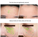 RF EMS Skin Tightening Device